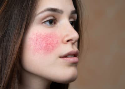 How to Know if It’s Redness or Rosacea