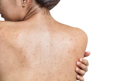 Back Acne for Beginners