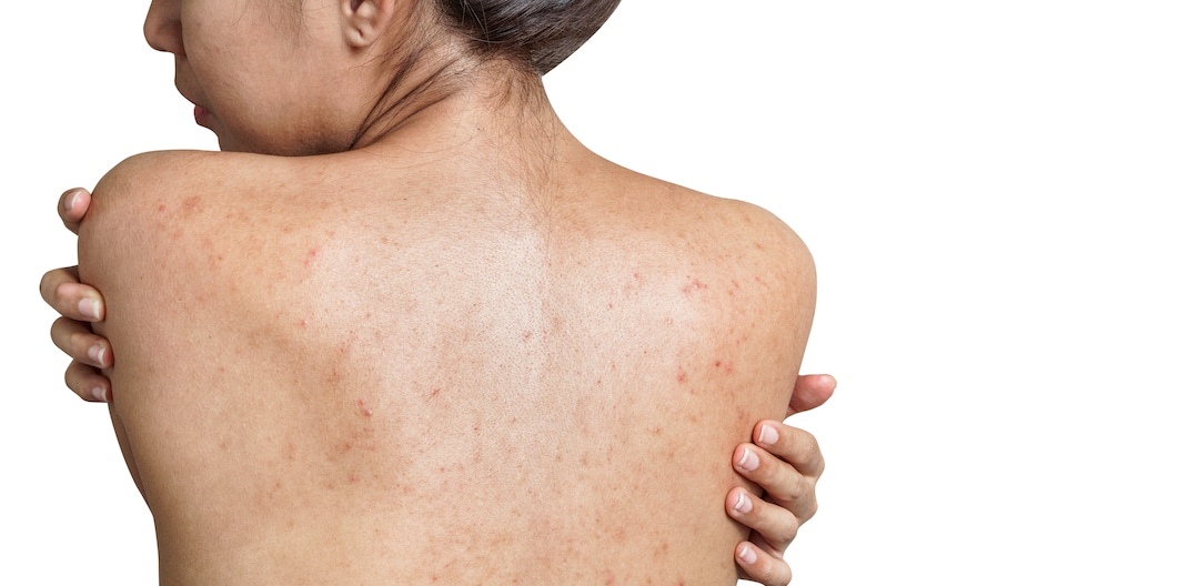 Back Acne for Beginners