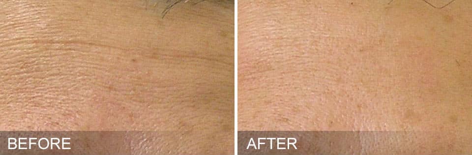 fine lines and wrinkles before and after image