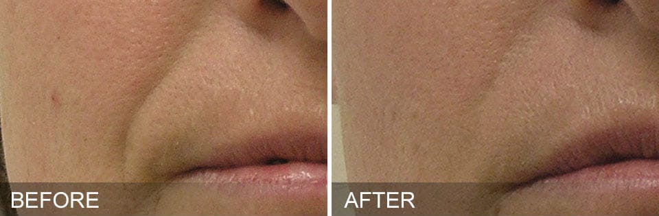 nasolabial folds before and after image