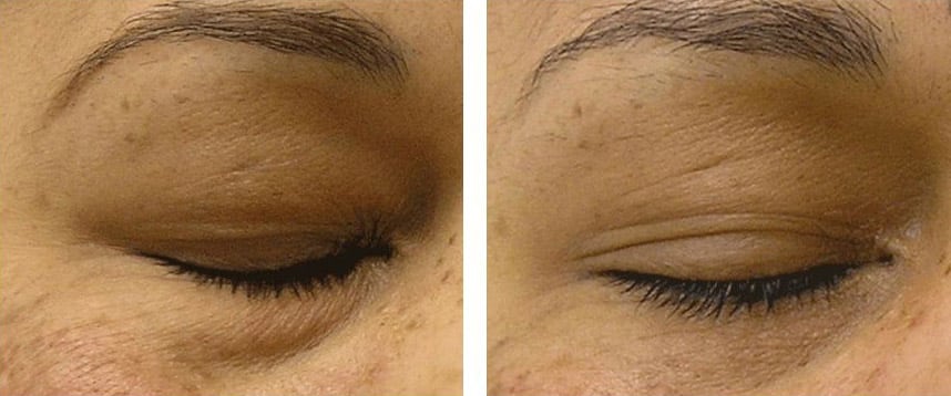 under eye puffiness before and after images