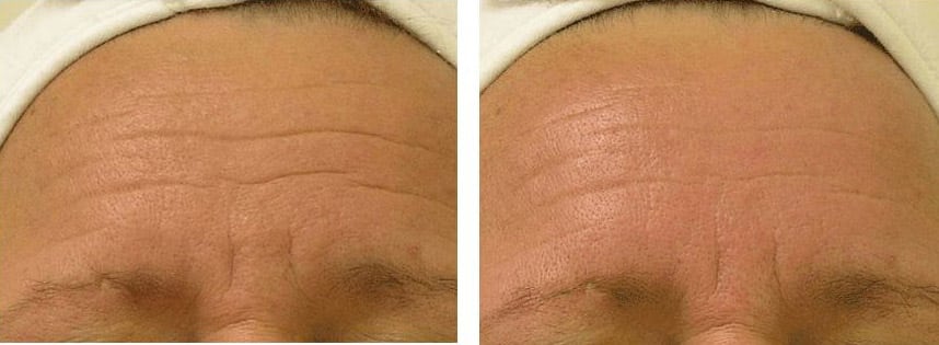 forehead wrinkles before and after images