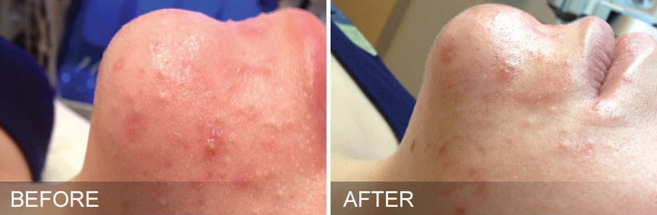 congested and acne prone skin before and after images