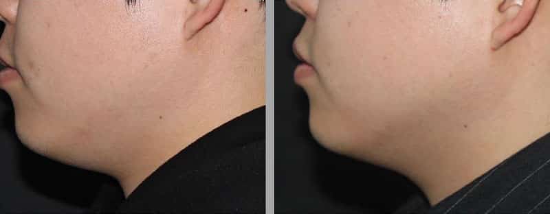 Before and after images of a man's double chin viewed from the side