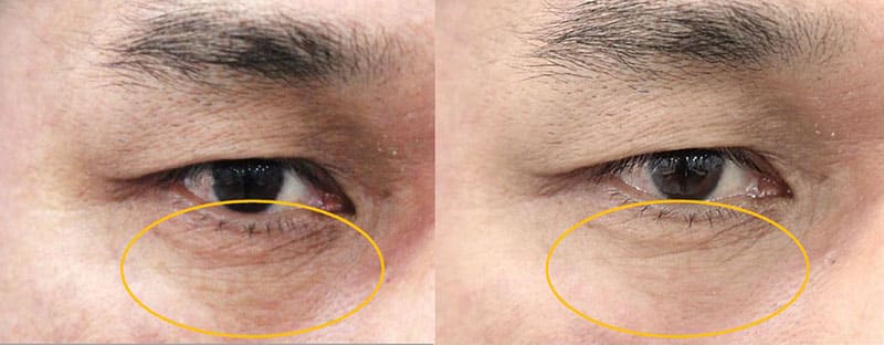 Before and after images with close-up of a man's eyes, the under eye area is circled