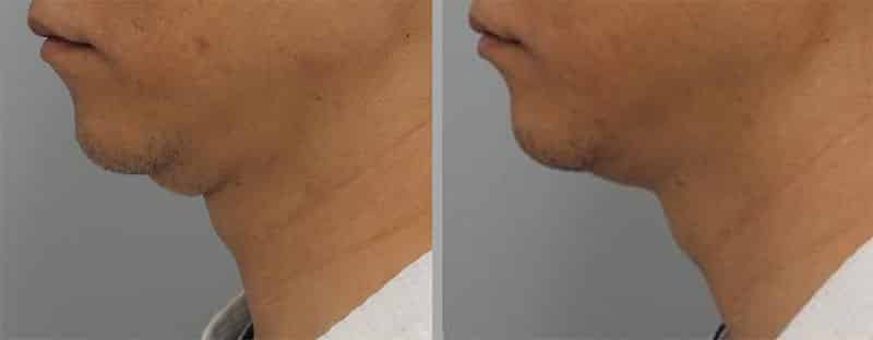 Before and after images of a man's double chin viewed from the side