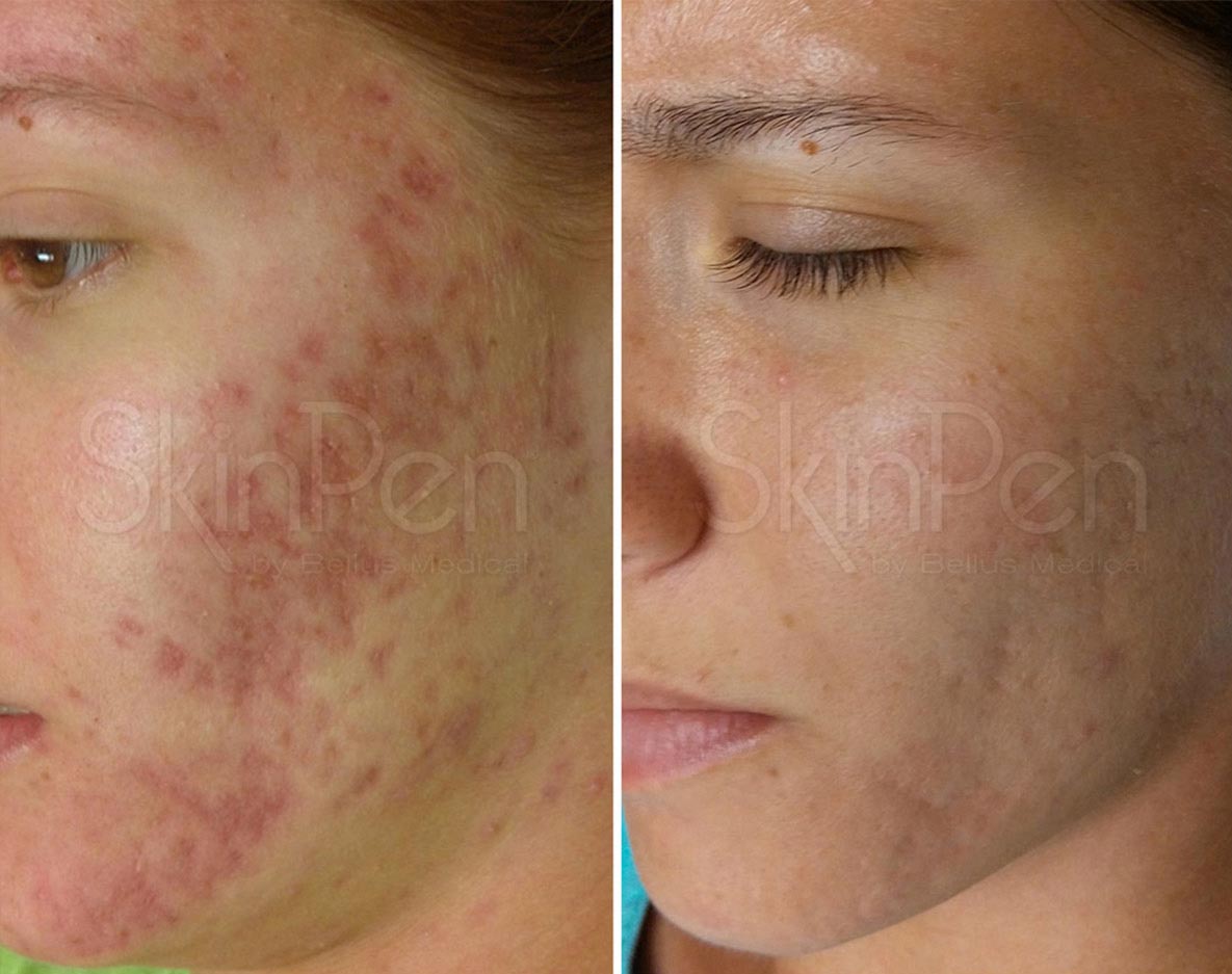 SkinPen microneedling before and after images