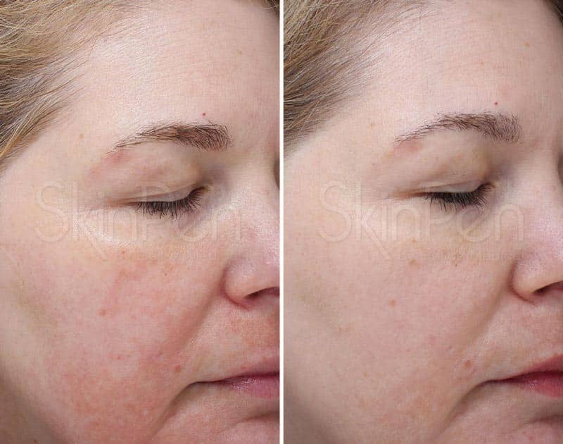 SkinPen microneedling before and after images