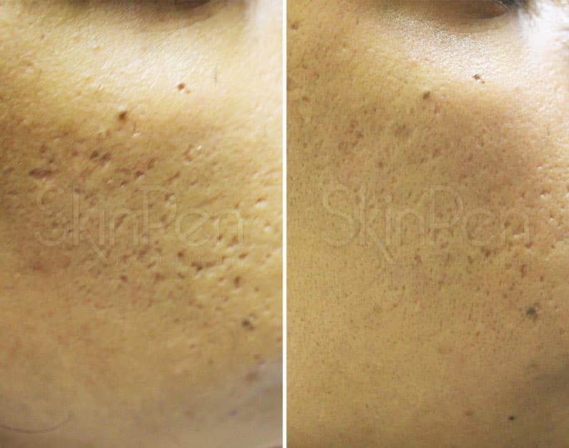 SkinPen microneedling before and after images