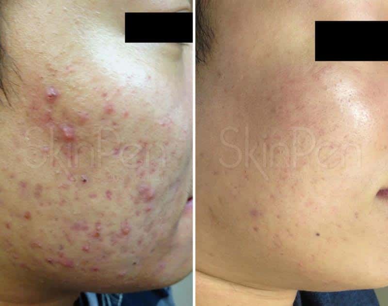 SkinPen microneedling before and after images