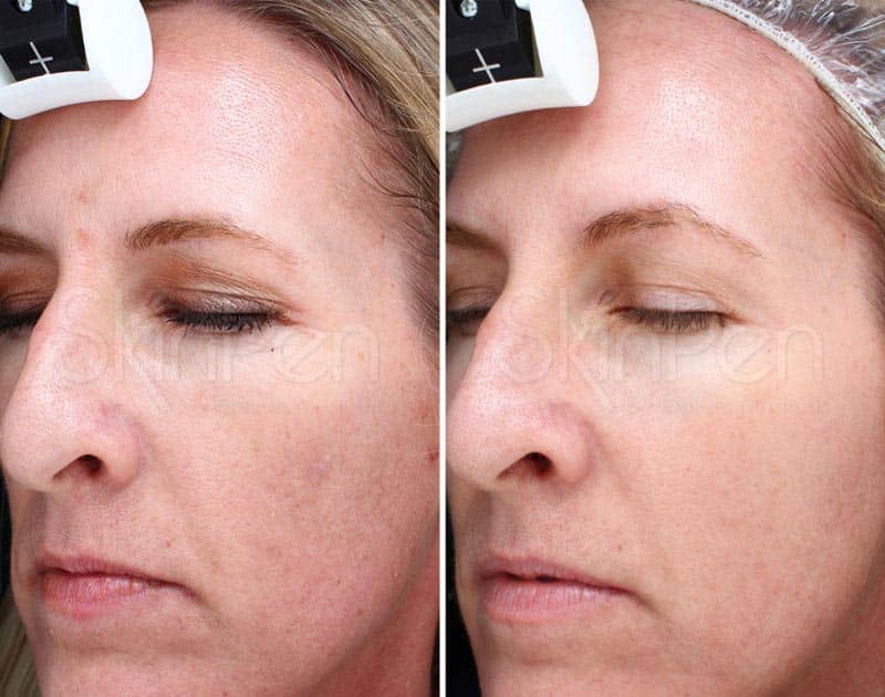 SkinPen microneedling before and after images