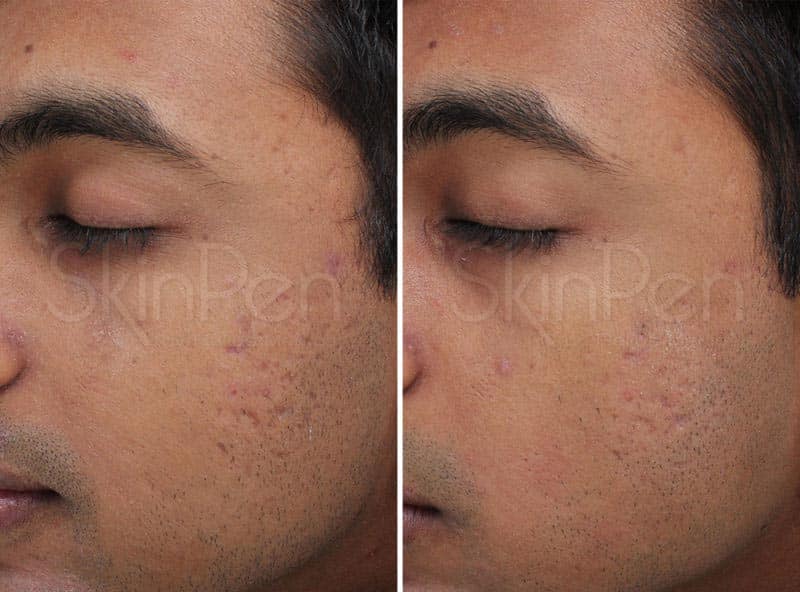 SkinPen microneedling before and after images