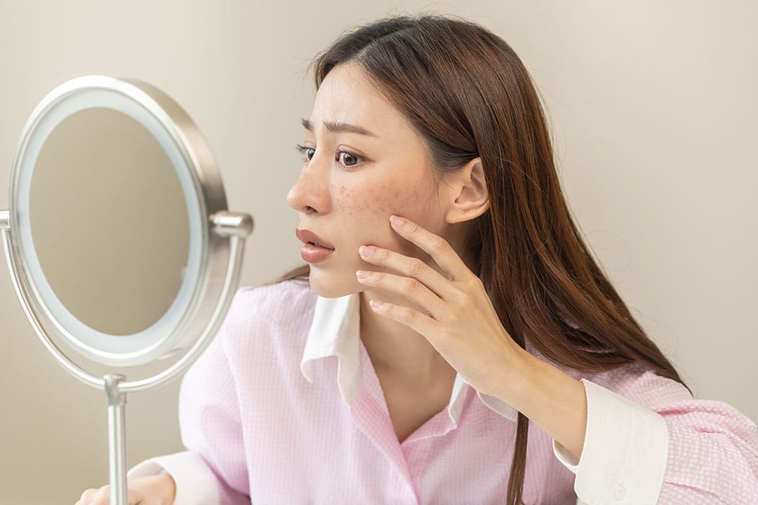 Young woman looking at her acne in a mirror
