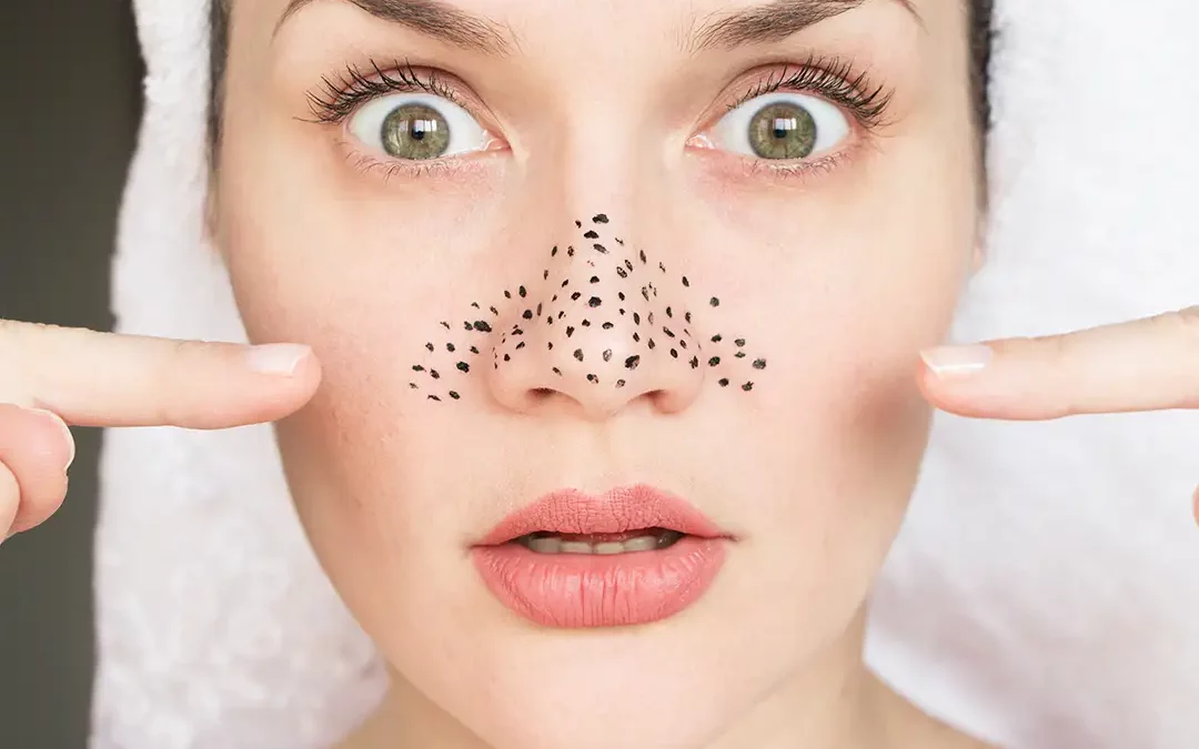 How You Can Clean Out Clogged Pores