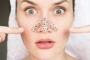 Woman's face with clogged pores across her nose