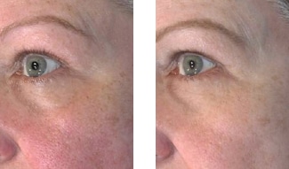 Vivace patient before and after images