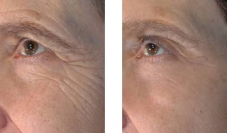 Vivace patient before and after images