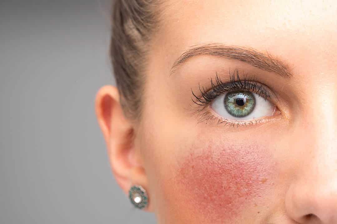 Young woman with rosacea on her cheek