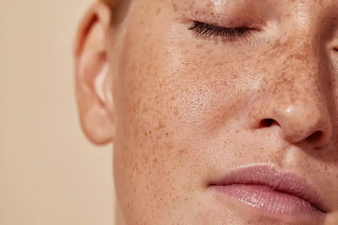 Woman's face with freckled skin