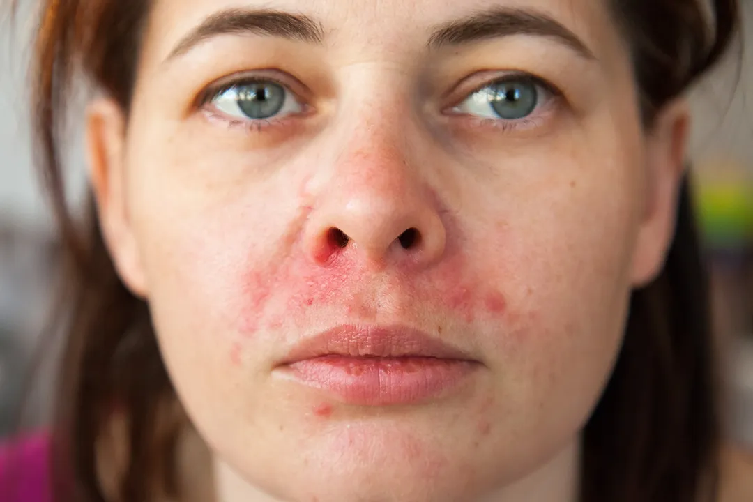 Woman's face with dermatitis