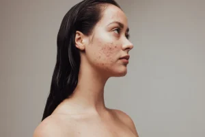 Young woman with acne on her face
