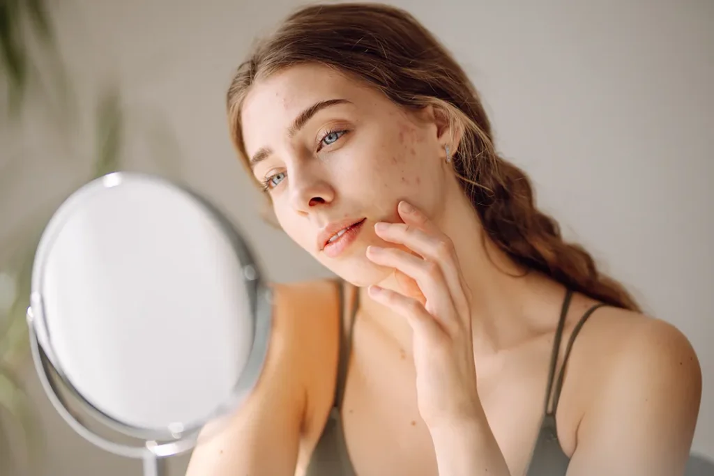 Young woman looking at acne on her face in a mirror
