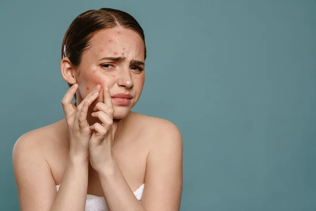 Young woman squeezing painful pimples
