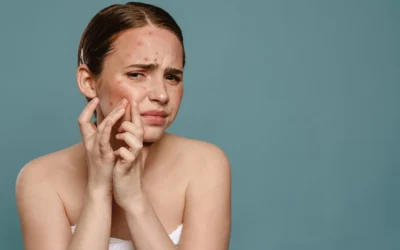 Acne Doesn’t Have to Mean Agony