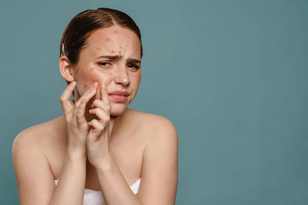 Young woman squeezing painful pimples