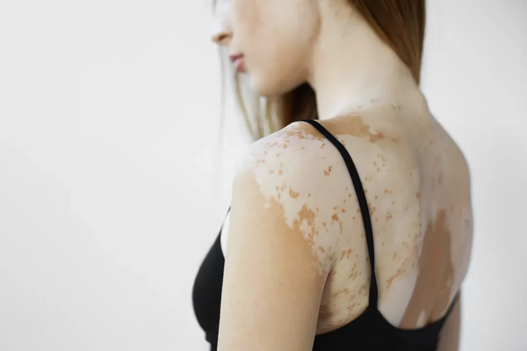 Woman with vitiligo