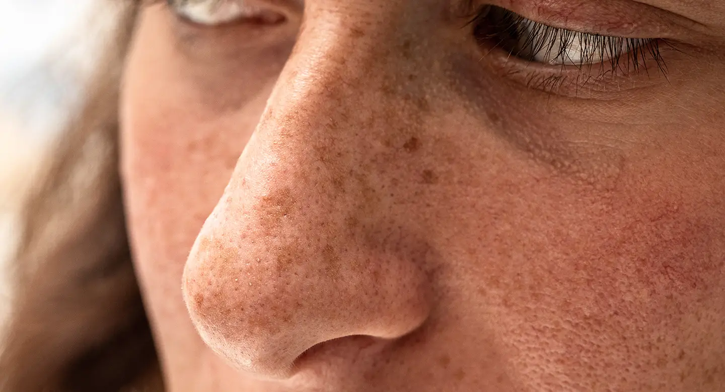 Pigmentation-Sun-Damage-01 Closeup of a woman with pigmentation from sun damage on her face