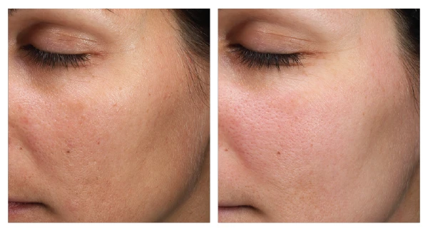 MOXI patient before and after photos