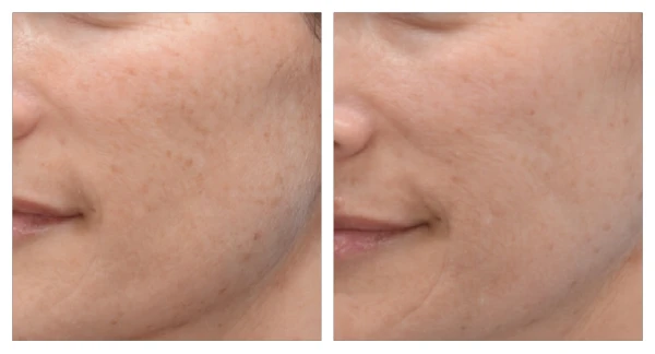 MOXI patient before and after photos