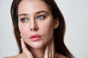 A young woman with acne touching her face
