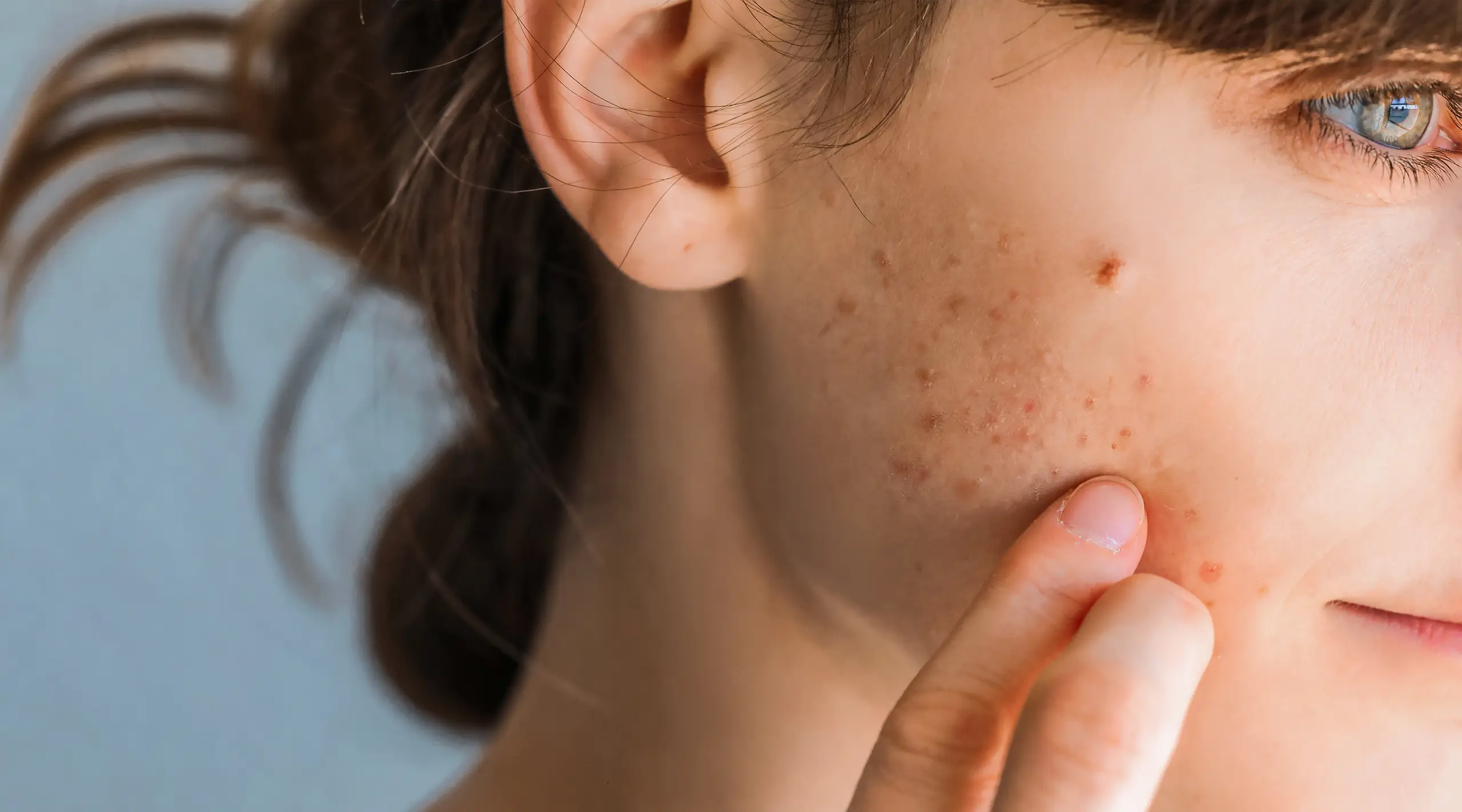 Acne-landing-page-header Woman with red sensitive skin