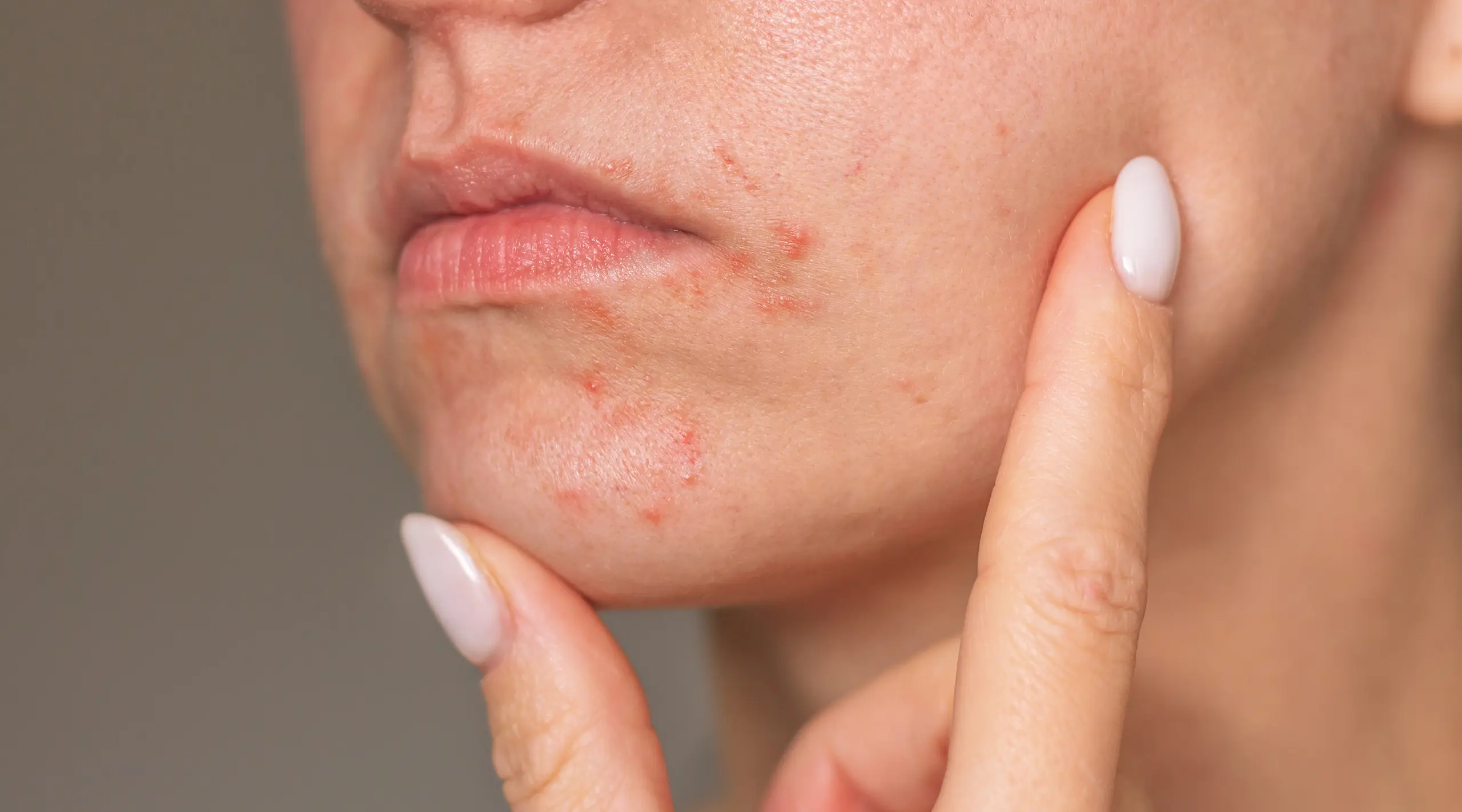 Woman with a skin condition on her face